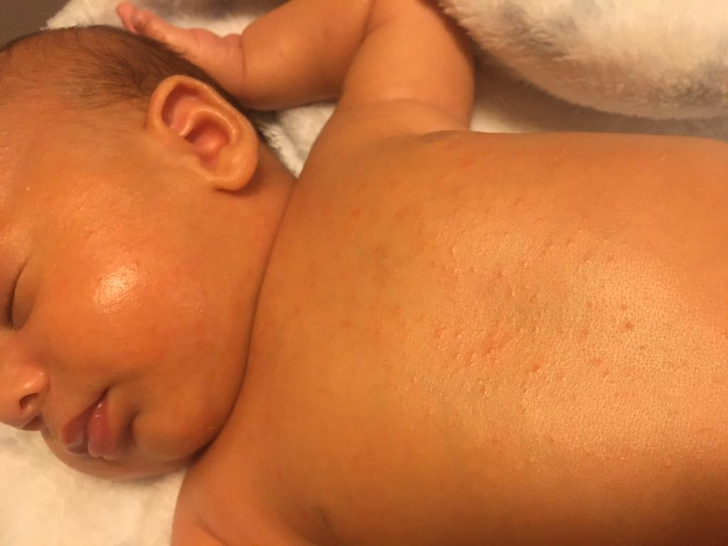 How to treat a milk allergy?