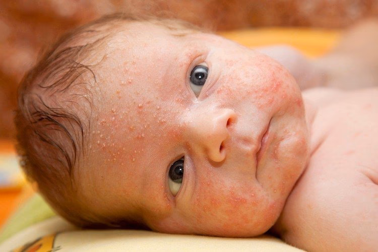 What causes baby milk allergy rash?