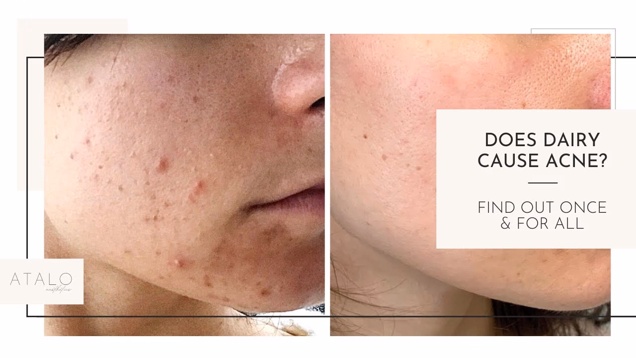 Can milk cause pimples?