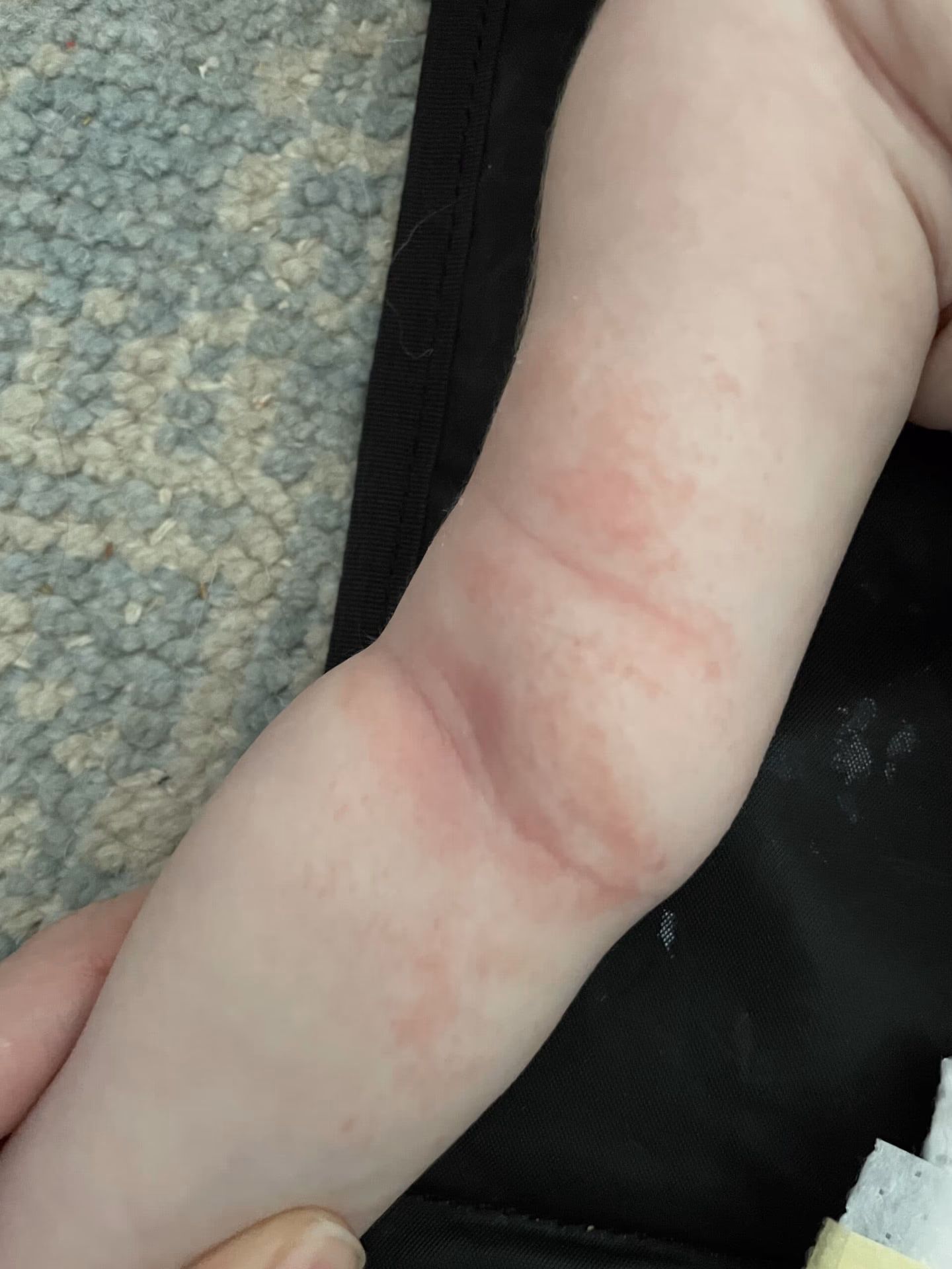 Can milk allergies be related to skin allergies?