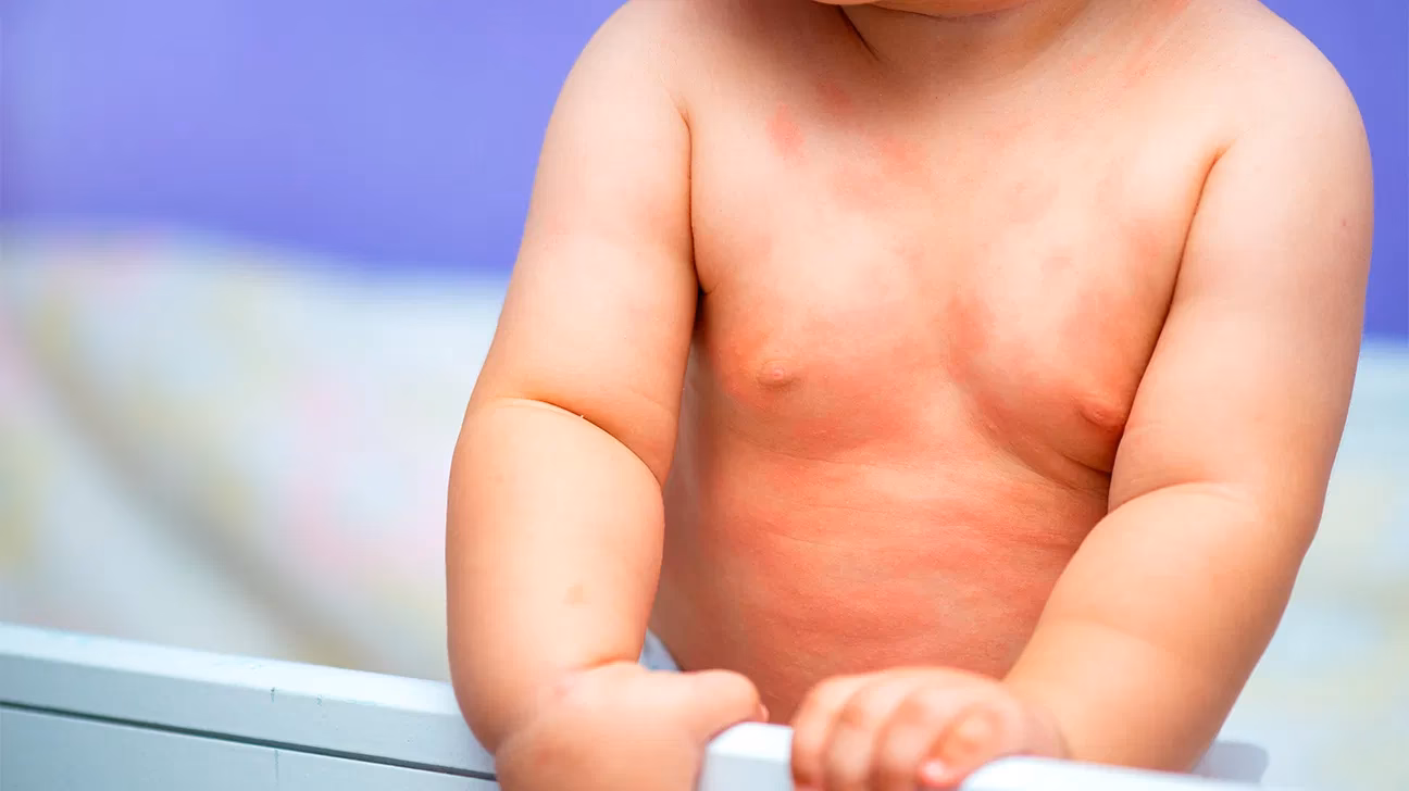 What is milk allergy?