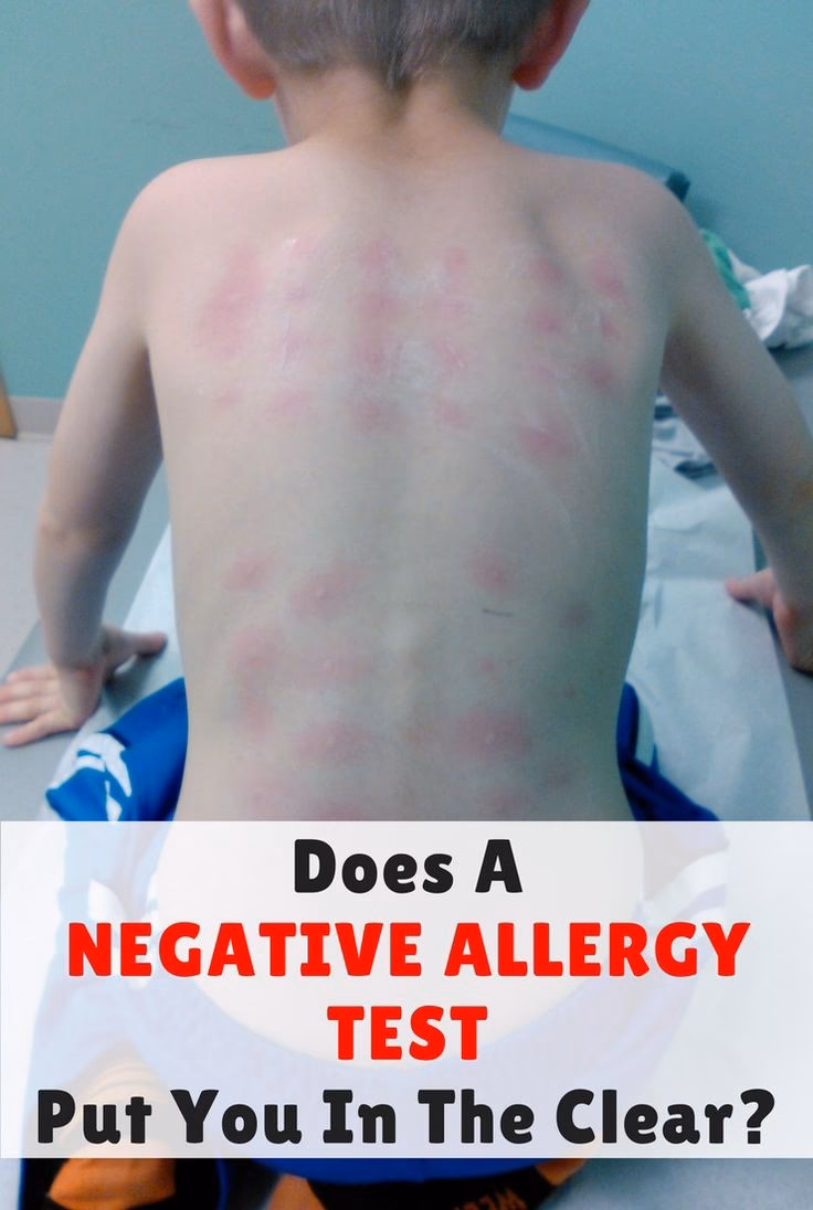 Can a milk allergy be misdiagnosed as lactose intolerance?