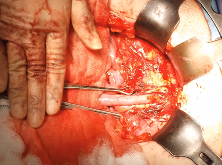 How does a Mitrofanoff work?