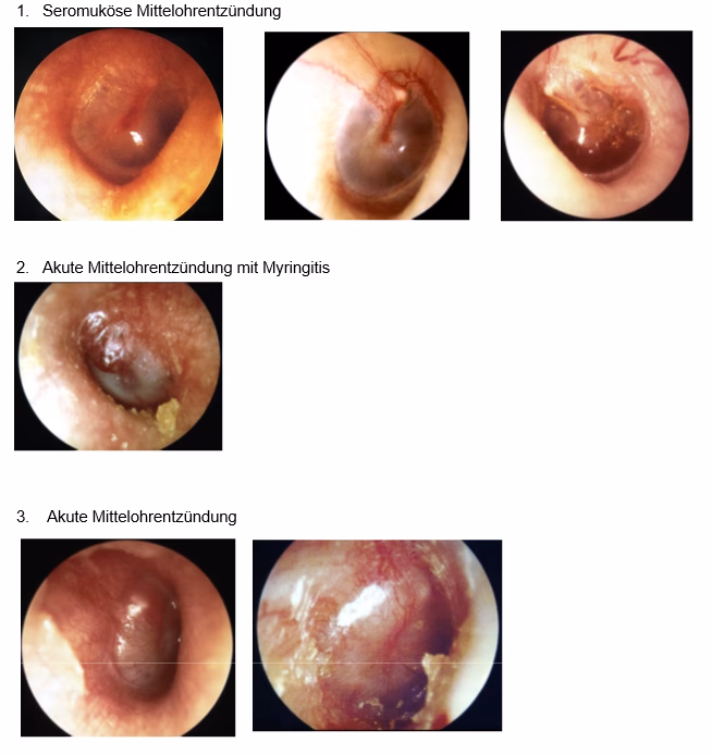Welche Antibiotika bei Mittelohrentzündung bei Kindern?