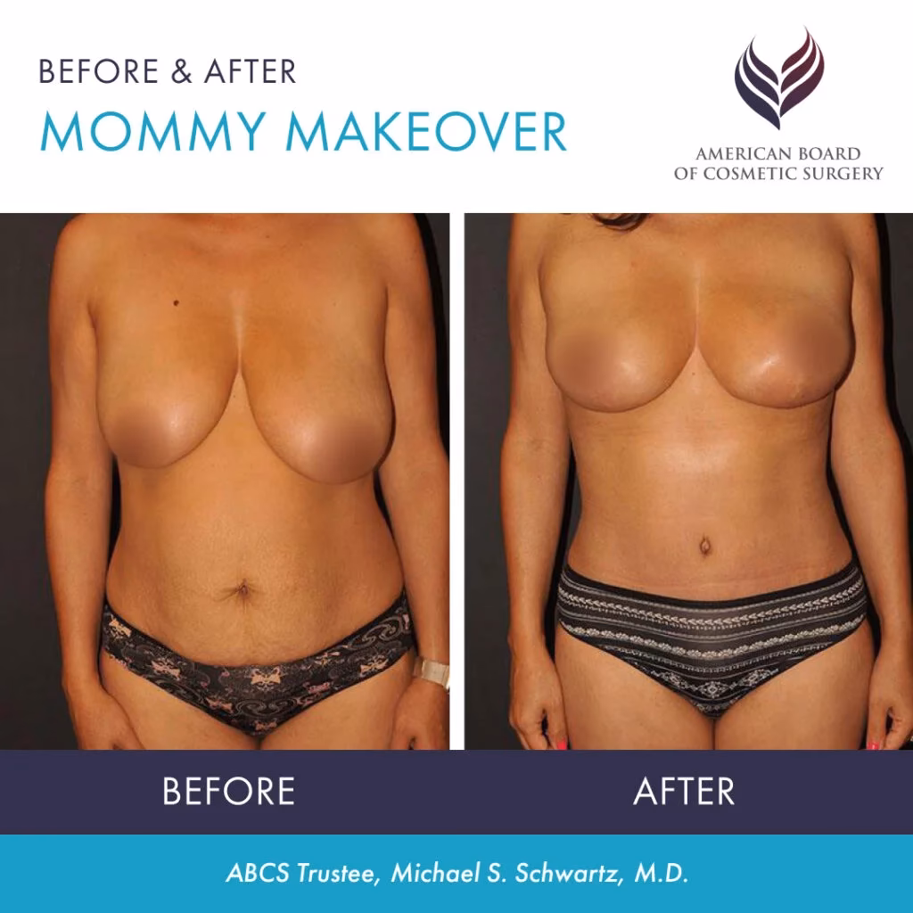What is a mommy makeover?
