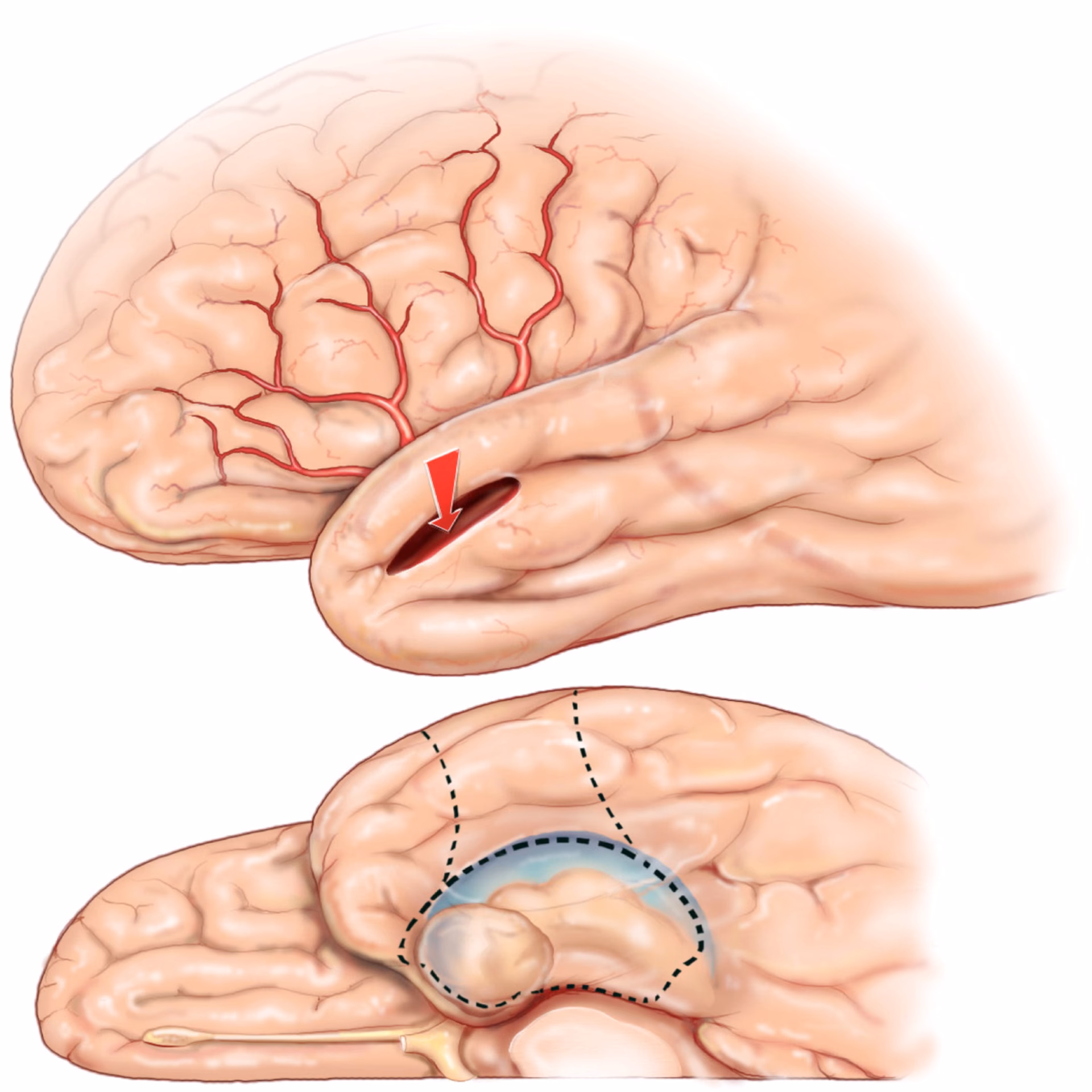 How important is laser interstitial thermal therapy for mesial temporal lobe epilepsy?