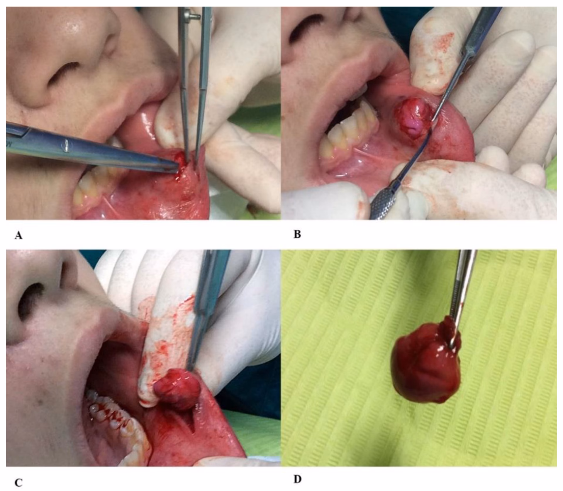 Can Oral mucocele be surgically managed by marsupialization?