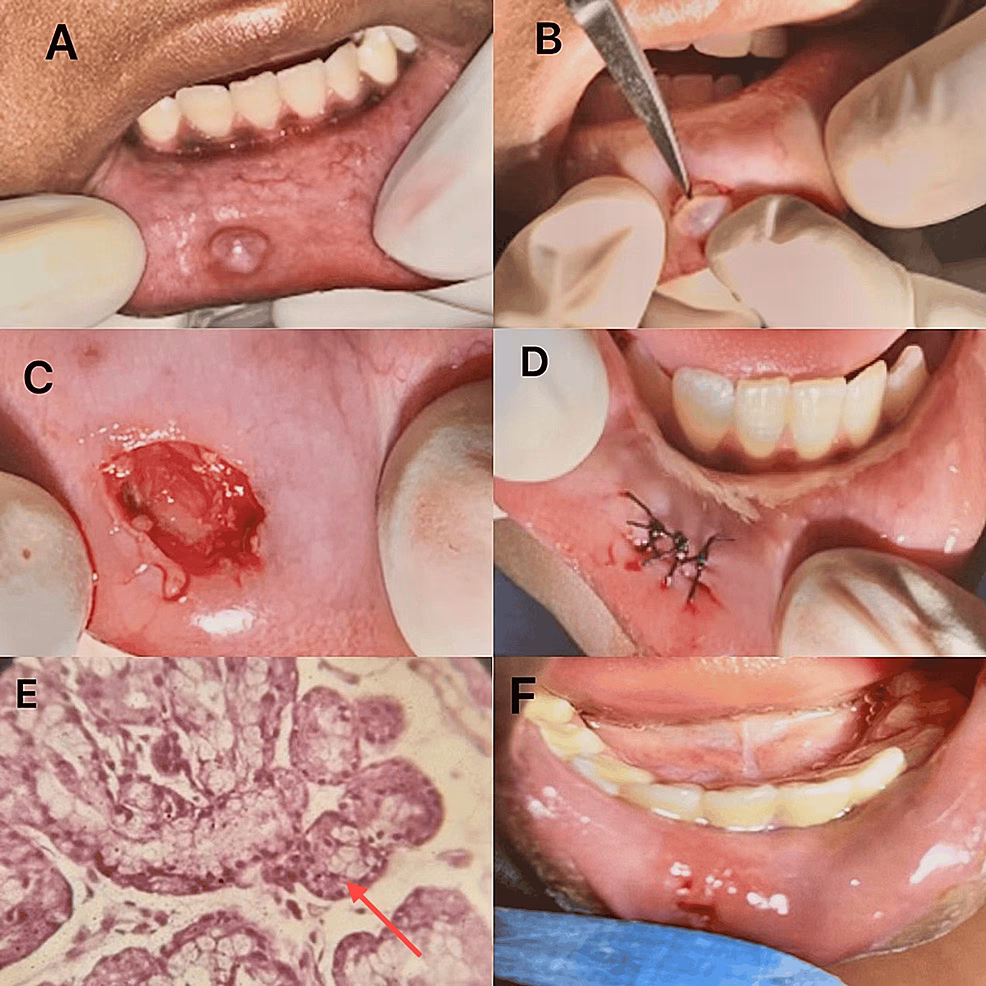 How effective is Oral mucocele surgery?