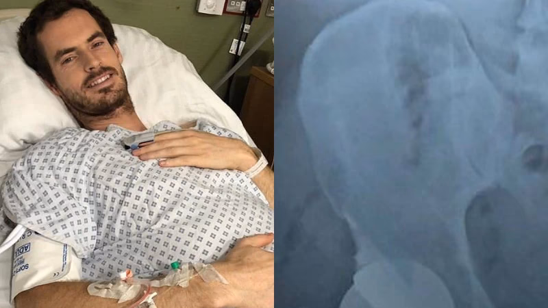 Why did Andrew Murray choose Birmingham hip resurfacing?