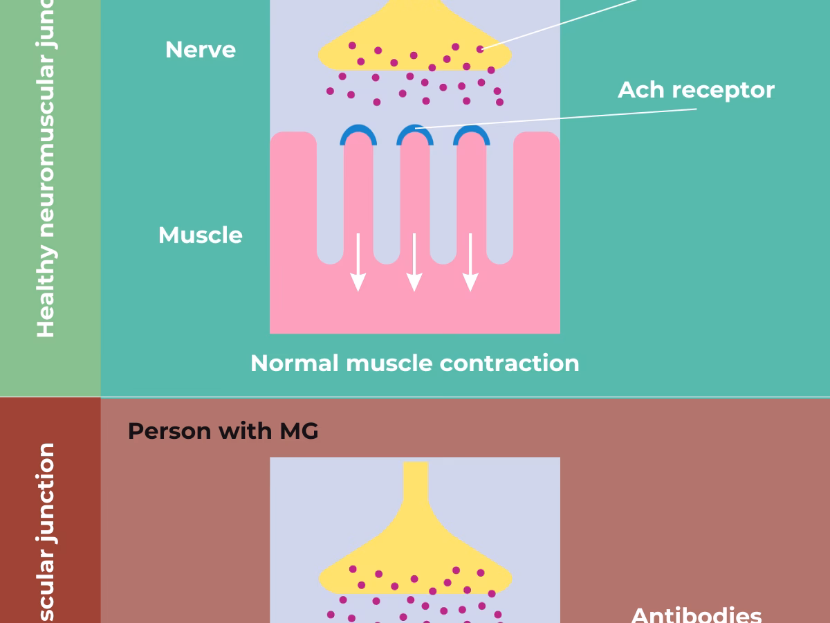 What is seronegative myasthenia gravis (MG)?