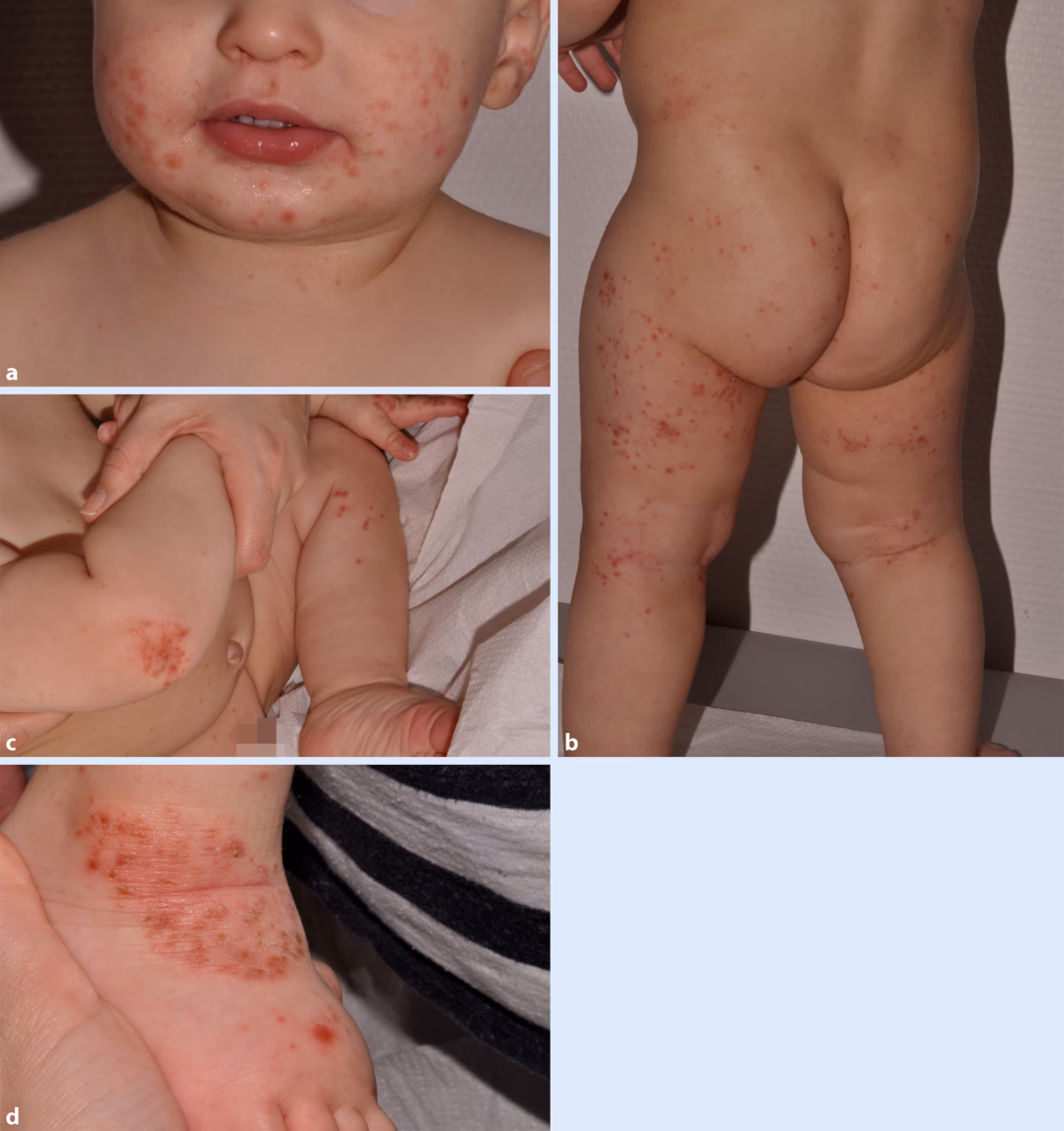 Wie äußert sich eine Mykoplasmen-Pneumonie bei Kindern?