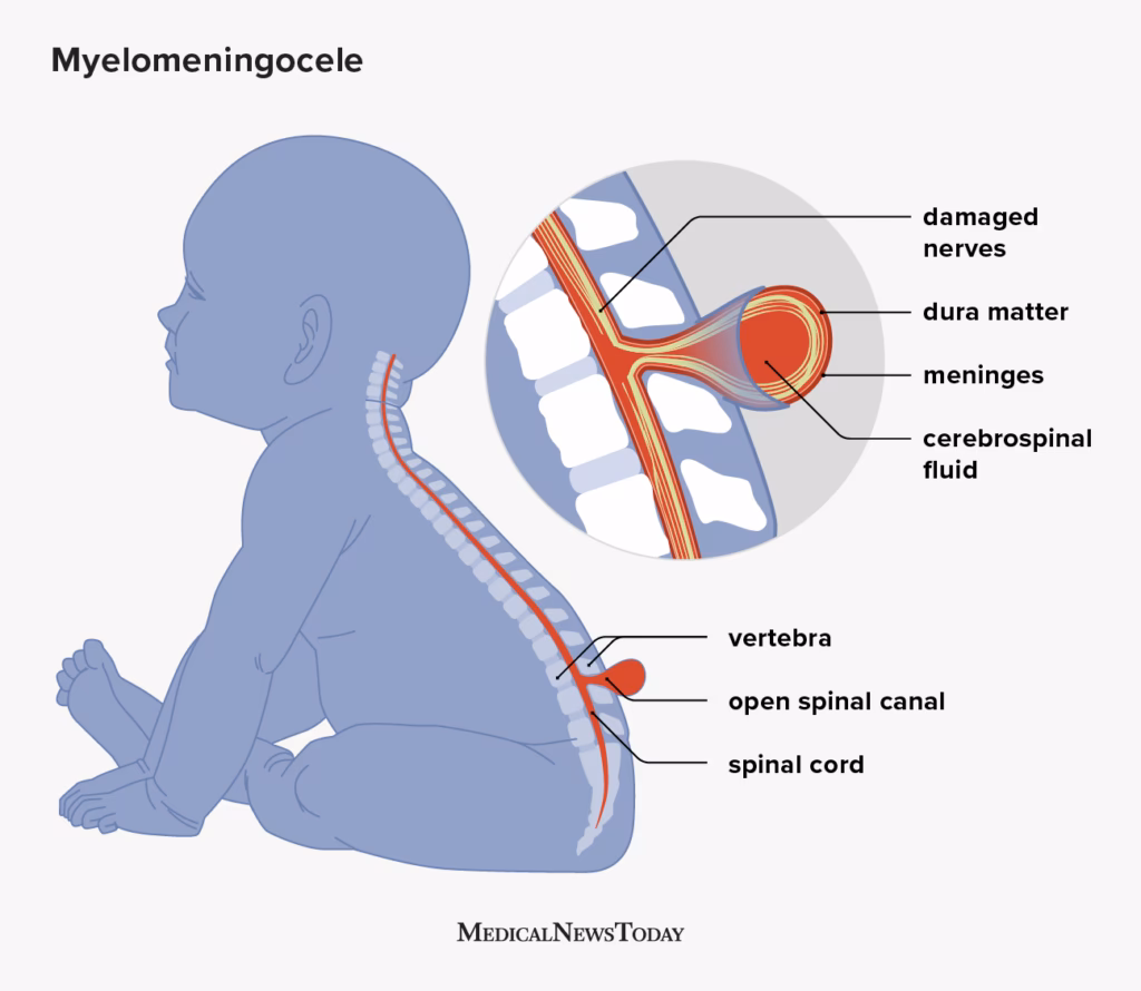How is body composition determined in children with myelomeningocele?