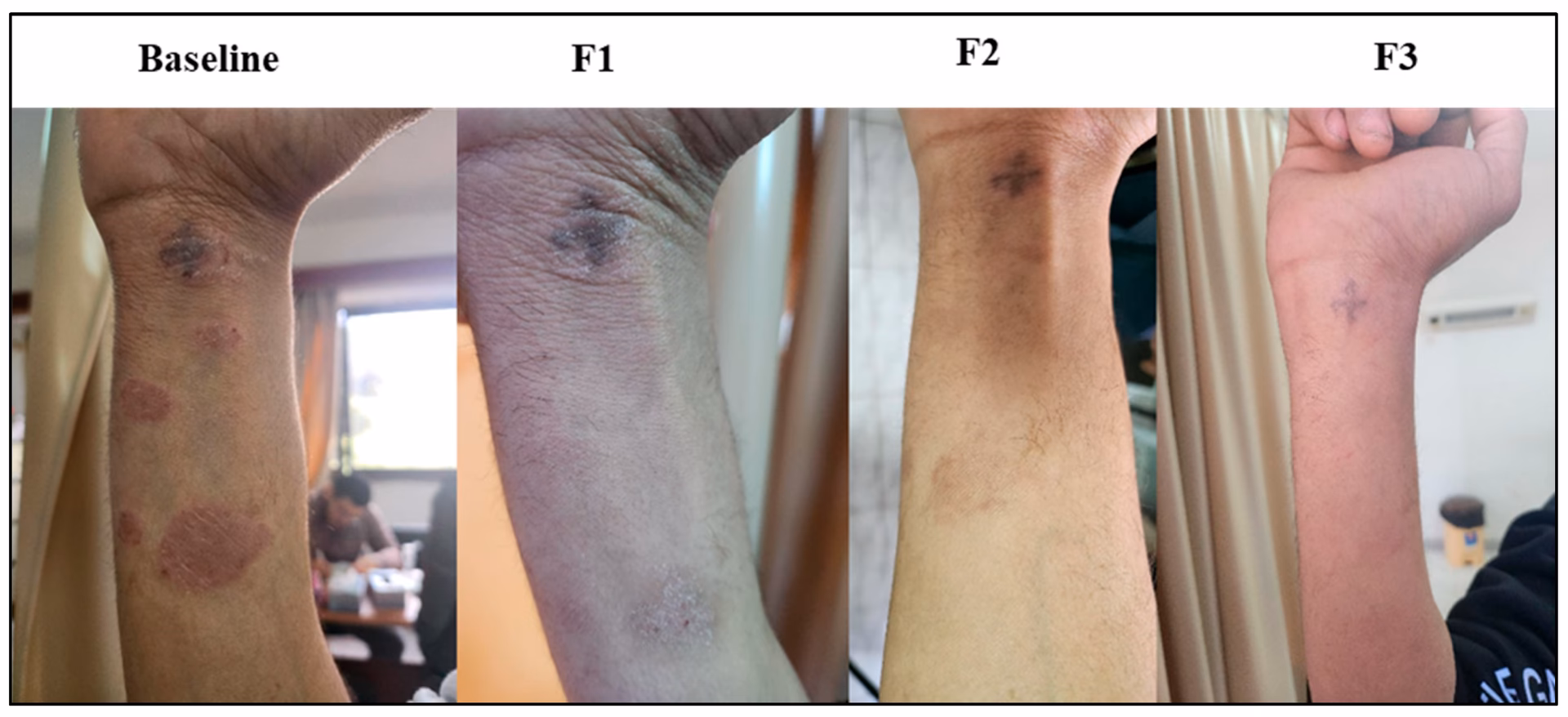 Is psoriatic arthritis a chronic inflammatory musculoskeletal disease?