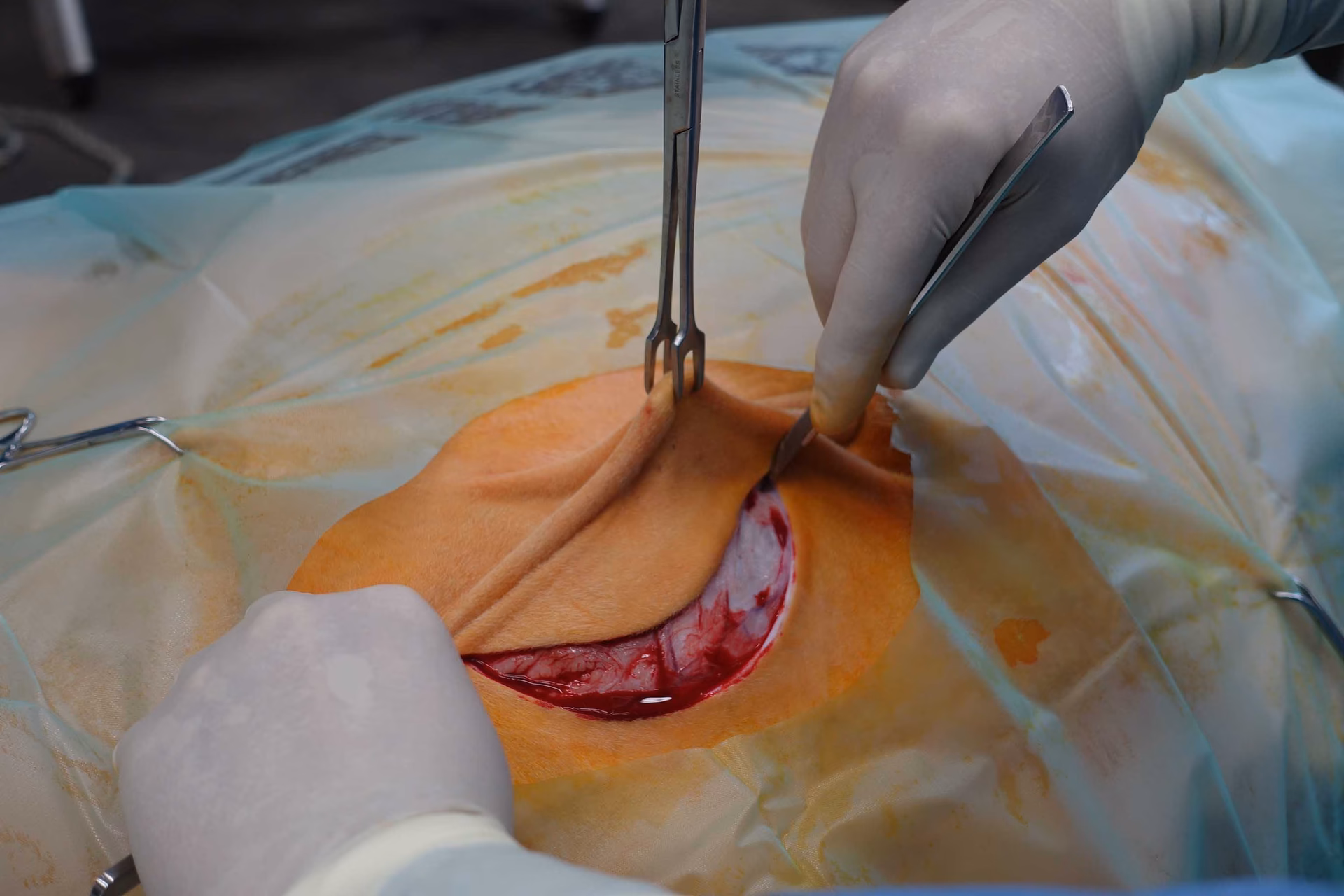 Was ist der Unterschied zwischen einer geschlossenen und einer offenen Nabelbruch-op?