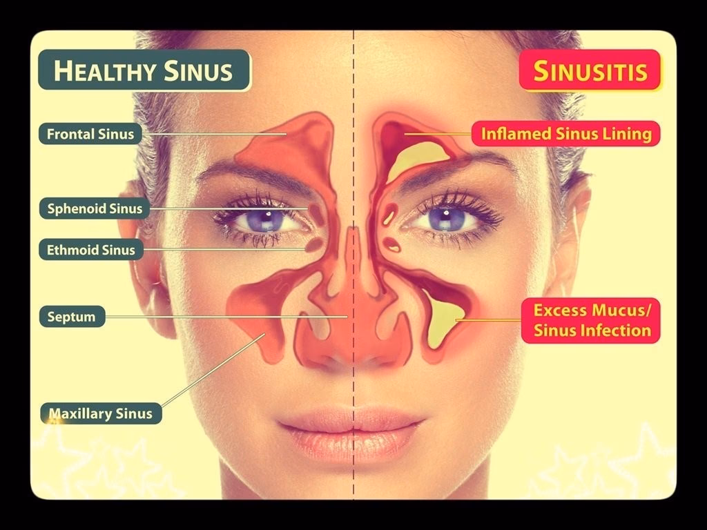 How common is allergic rhinitis in Bangalore?
