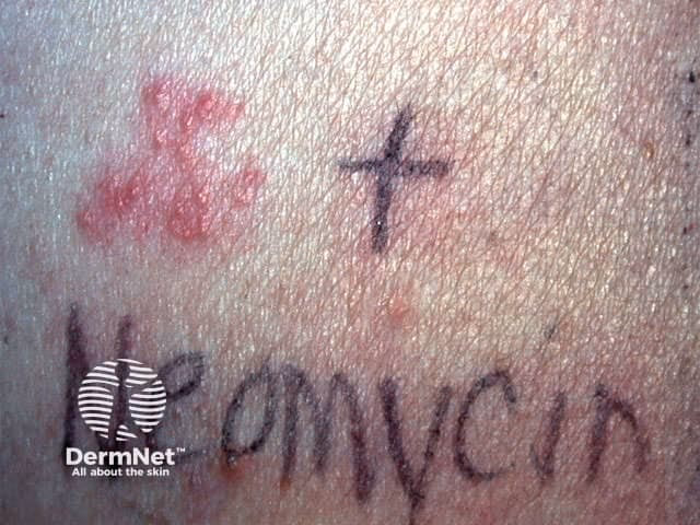 Is neomycin A contact allergen?