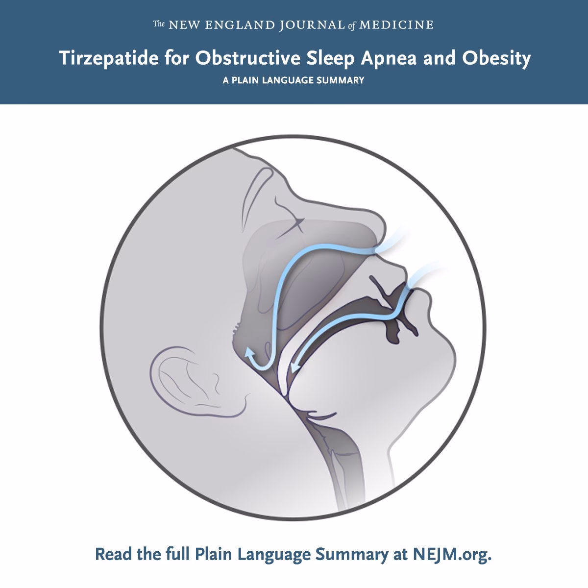 Is tirzepatide a potential treatment for obstructive sleep apnea?
