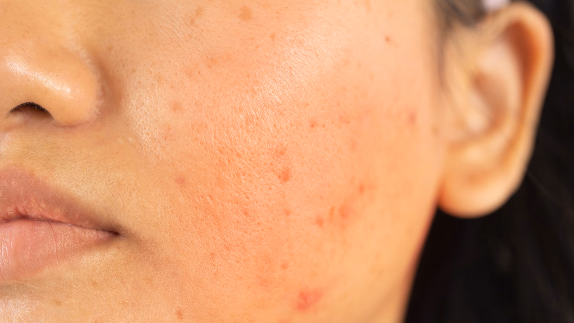 What is a niacin reaction?