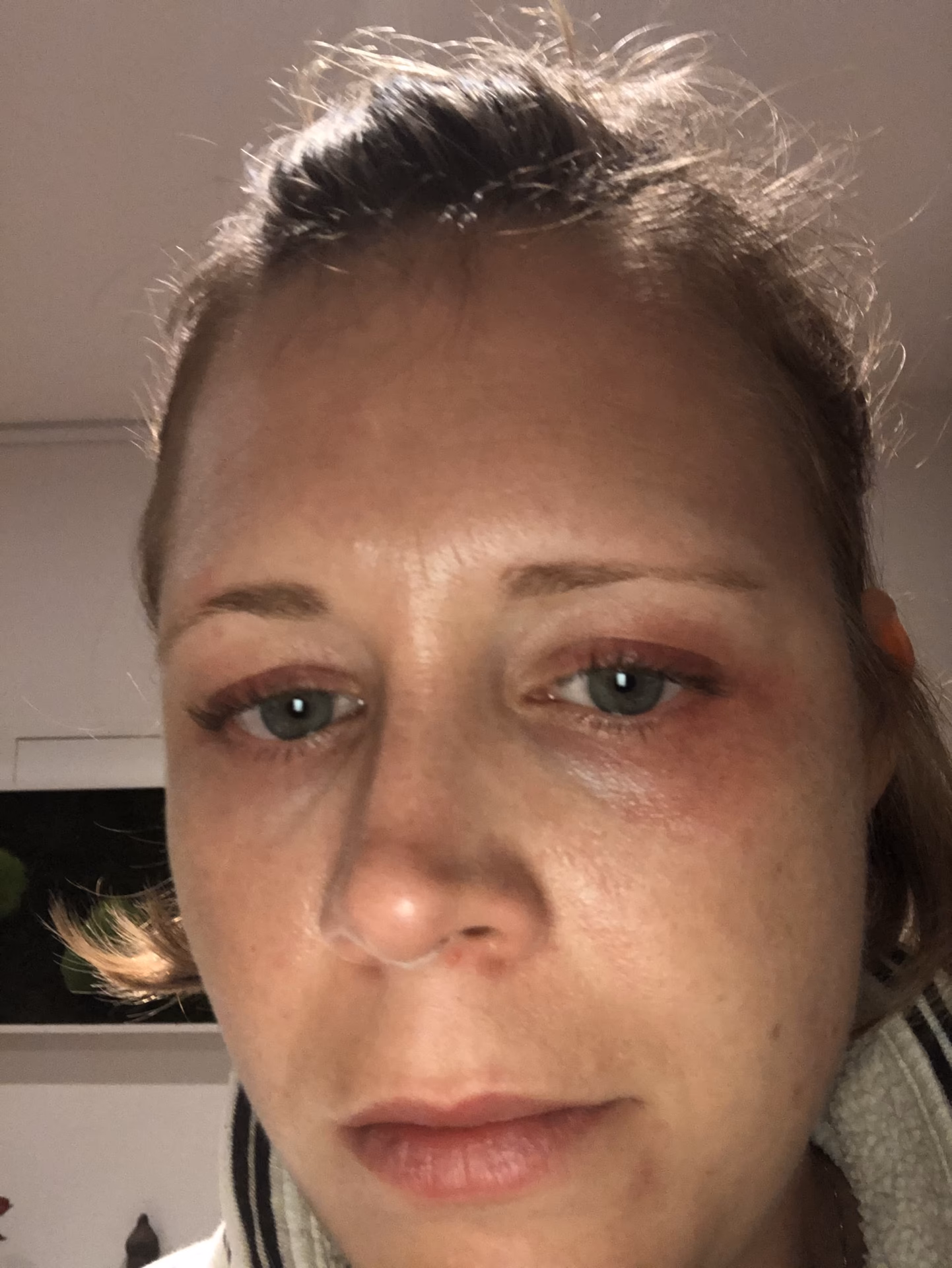 Can a nickel allergy cause a rash?