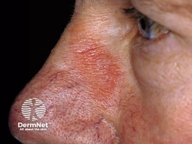 Can a nickel allergy cause a rash?