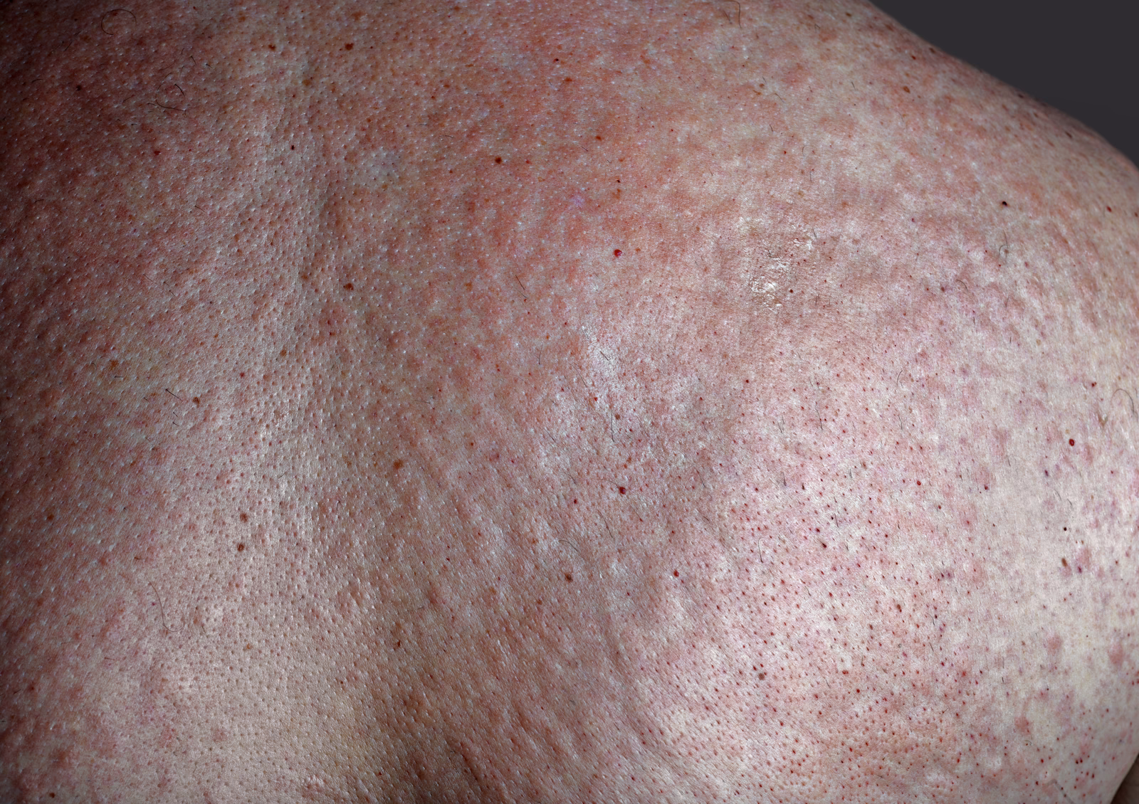 Can dietary nickel cause rosacea?