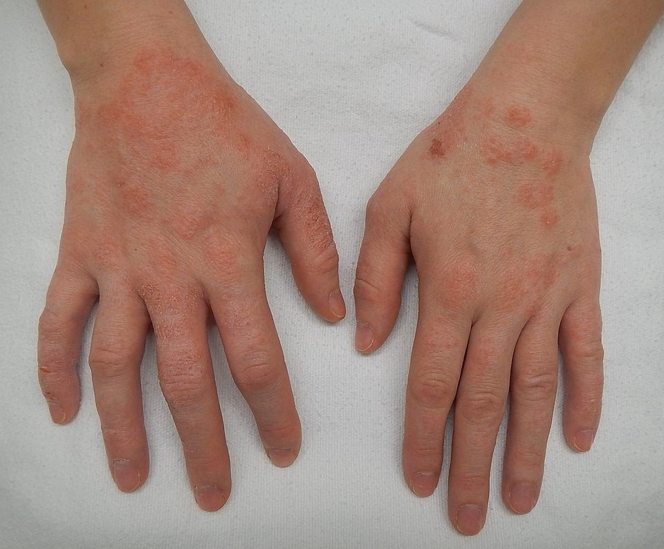 Is nickel allergy a common cause of contact dermatitis?