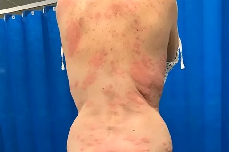 Do you have a nicotine allergy?