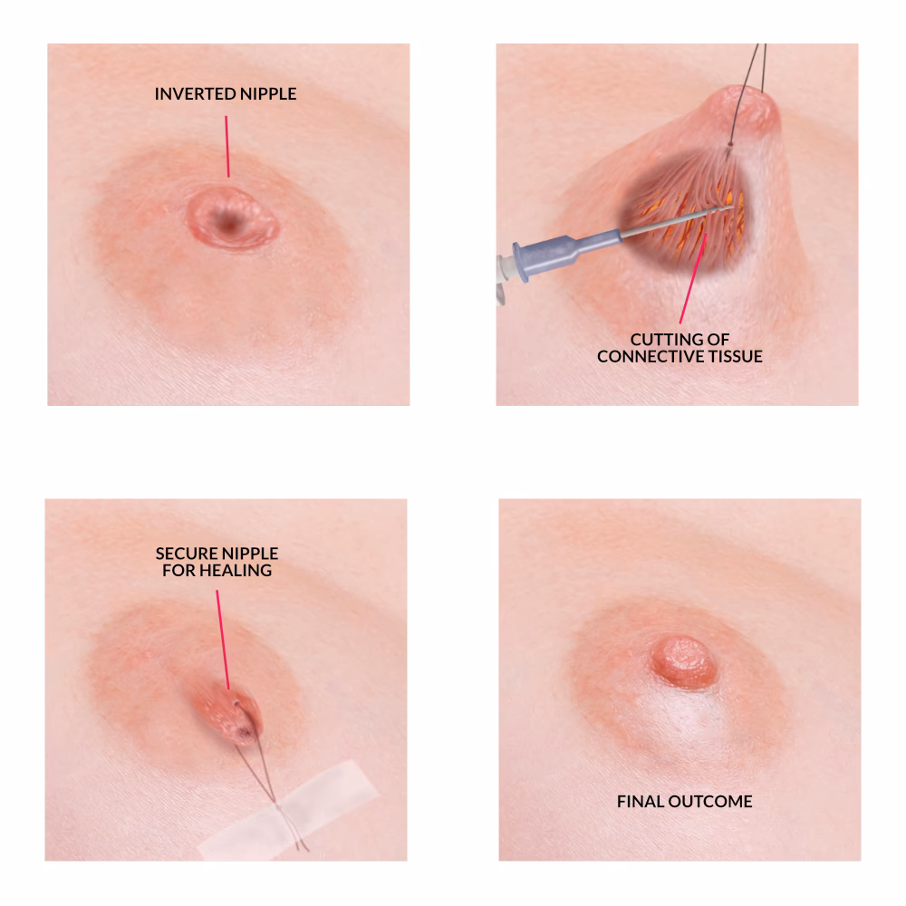 Does insurance cover nipple surgery?