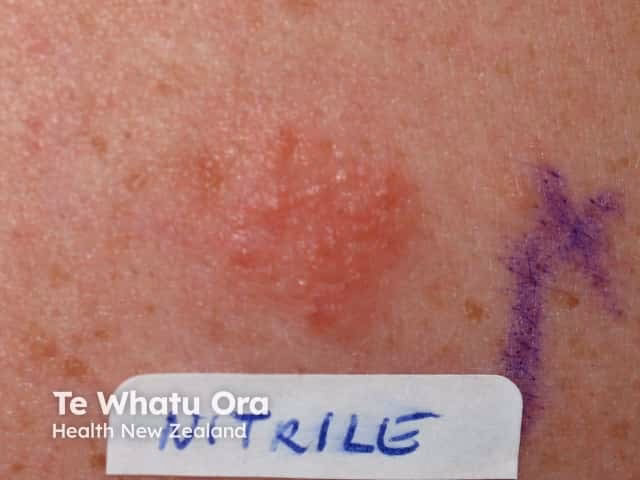 Can accelerator free nitrile gloves help with allergies?