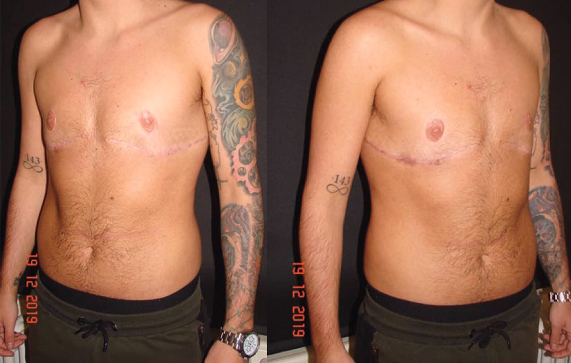 Are nipple grafts prone to epidermolysis?