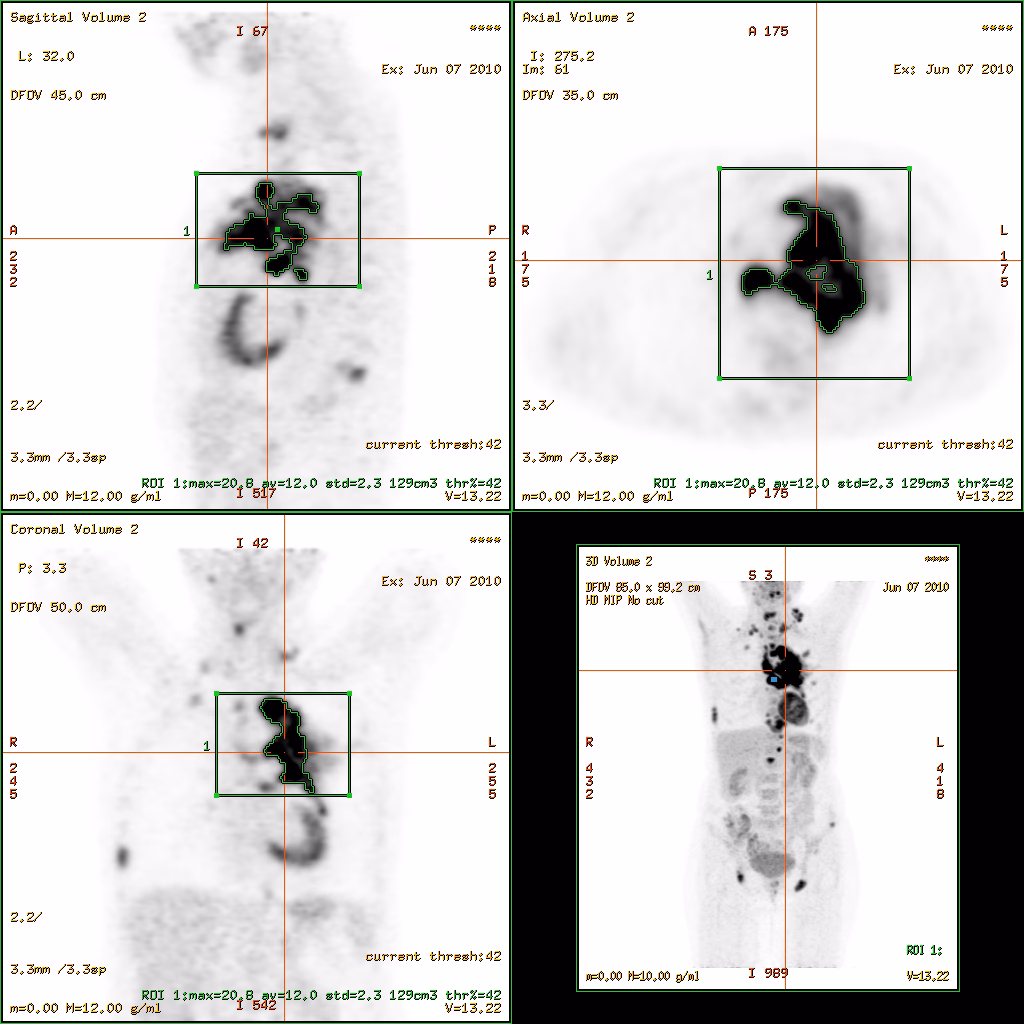 What is Standardized Uptake Value (SUV) in positron emission tomography (PET)?