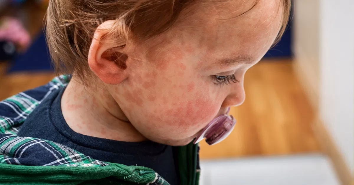 What foods should a baby eat if he has a food allergy?