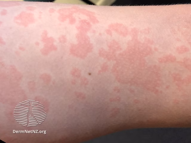 How do nut allergies affect your skin?