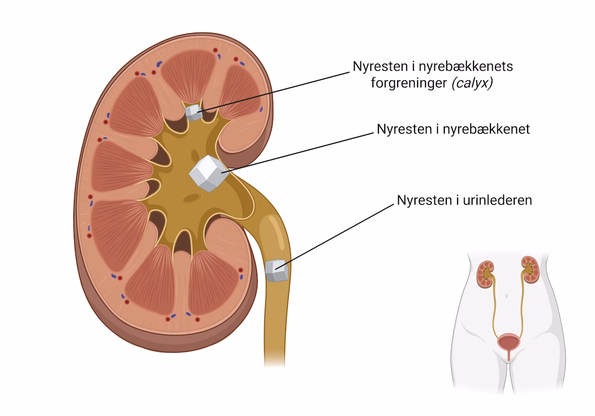 Hvad øger risikoen for nyresten?
