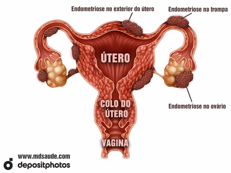 Qual a diferença entre endometriose e câncer?