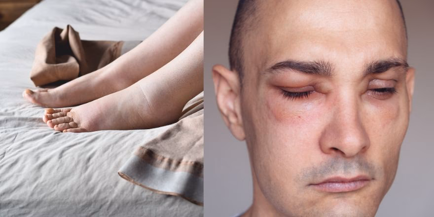 Was ist eine Allergie?