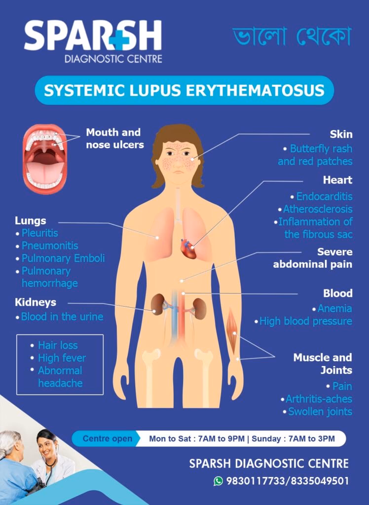 What causes systemic lupus erythematosus (SLE)?