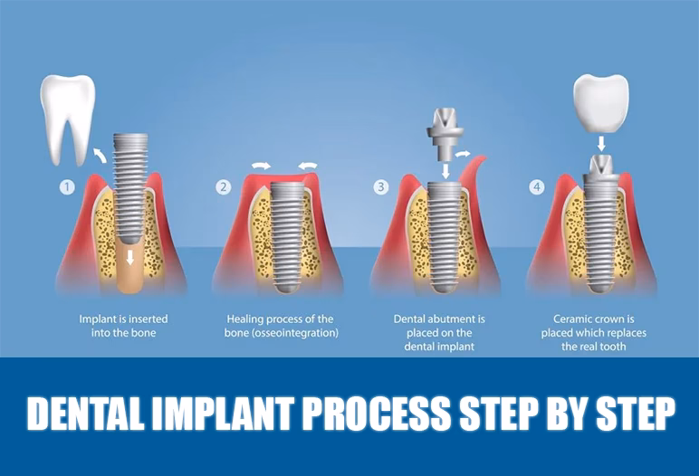 How do you solve one step equations using inverse operations?
