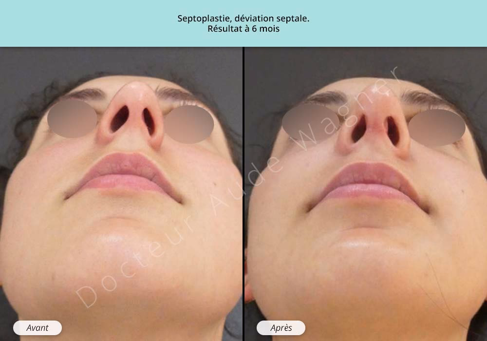 Quels sont les symptômes d'une perforation de la cloison nasale ?