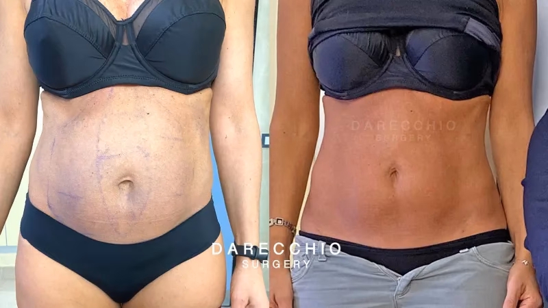 What is the diastasis project?