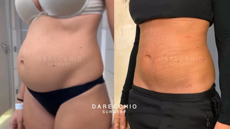 How long does it take to get rid of diastasis recti?