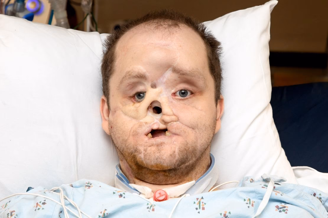 What are the different types of facial surgery for a paralyzed face?