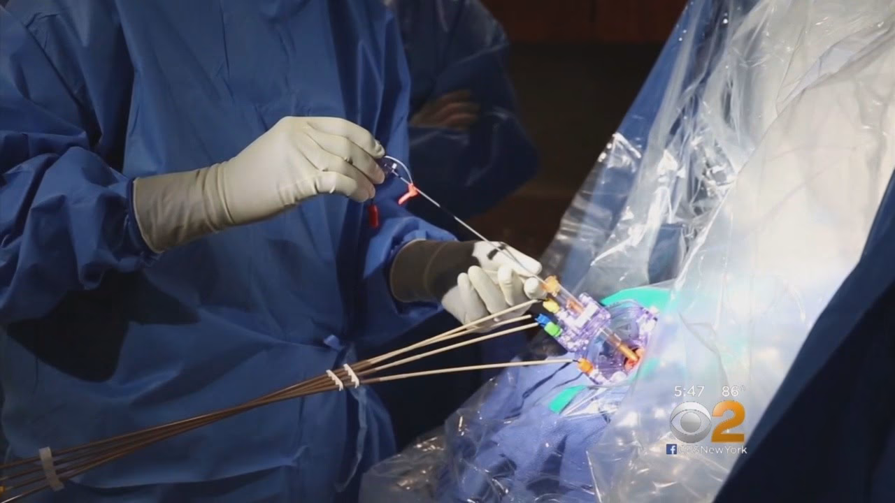 What is a brain surgery for OCD?