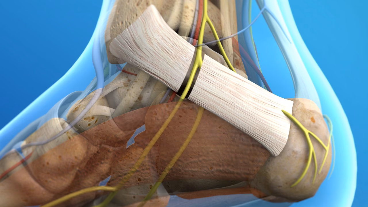 What is the best treatment for tarsal tunnel syndrome?