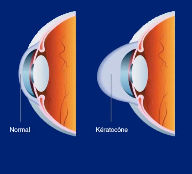 Quels sont les symptômes du kératocône ?
