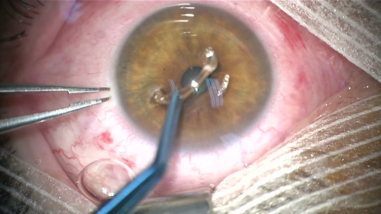 Quels sont les symptômes du kératocône ?