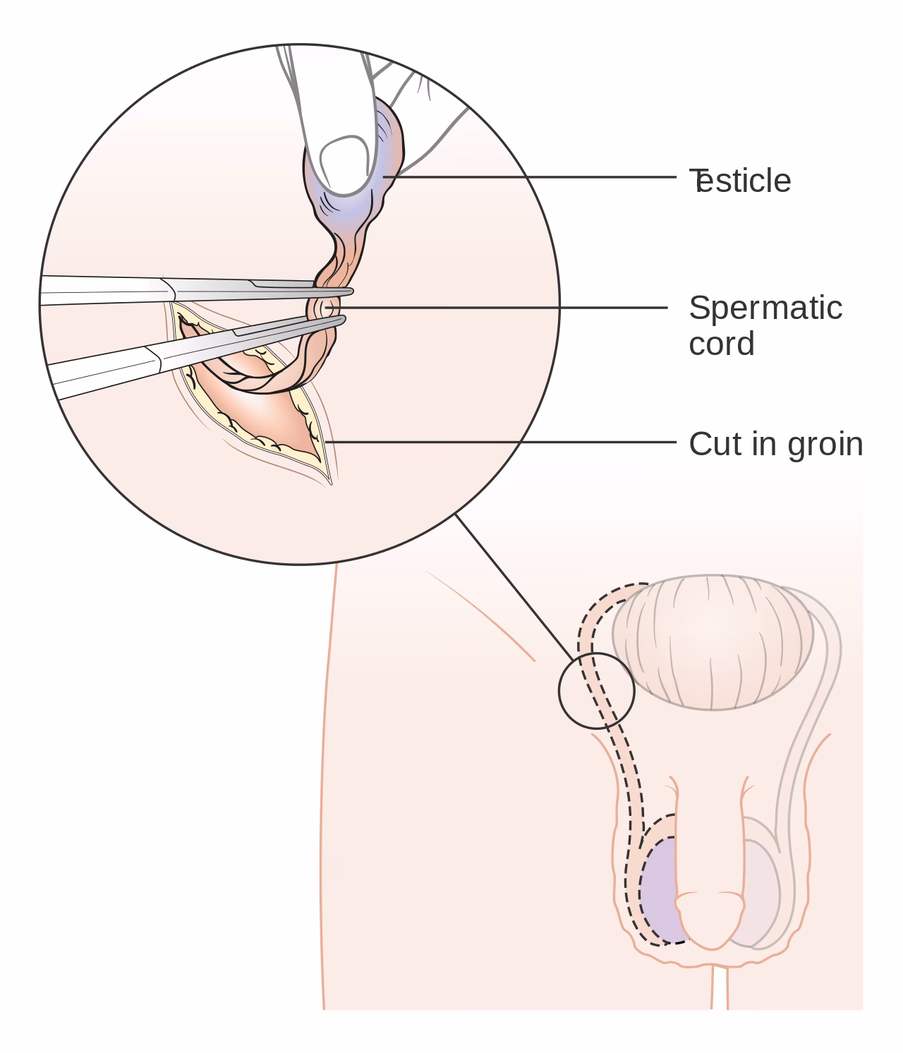 What are the steps in an orchiectomy?