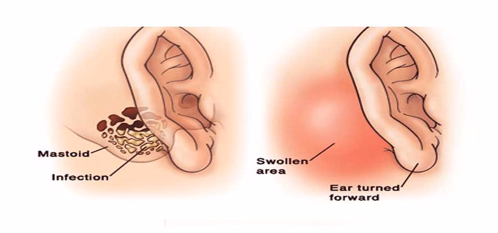 What are the different types of mastoidectomy procedures?