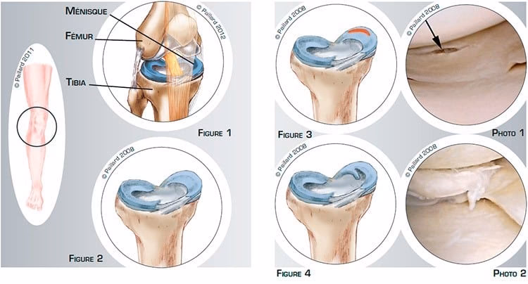 Qu'est-ce que la suture du ménisque ?