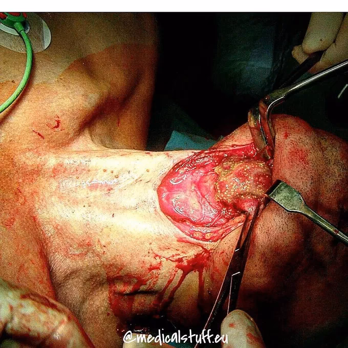 What should I do if I have a goiter?